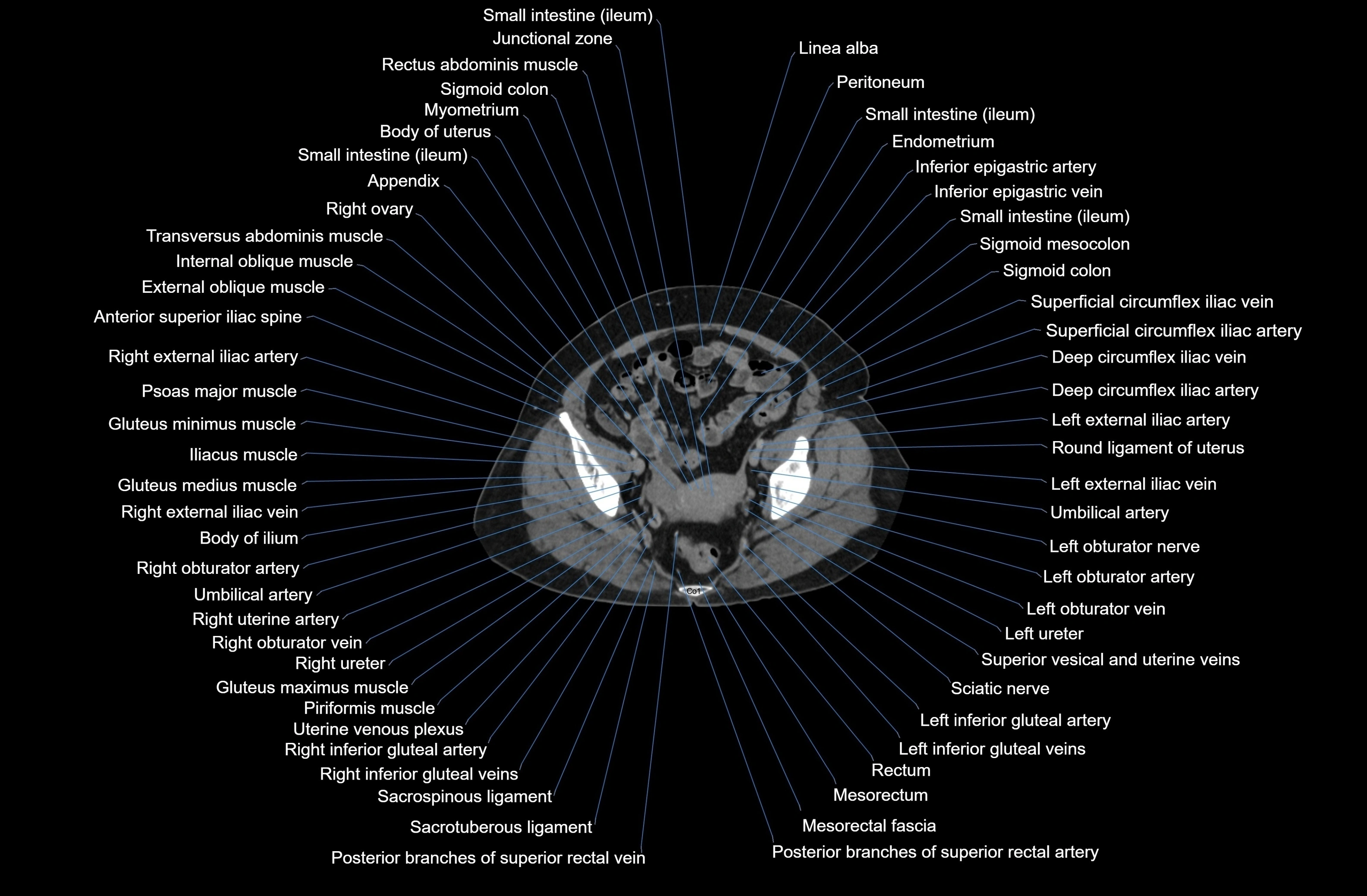 CT Abdomen axial cross sectional anatomy labelled radiology image-00083.webp